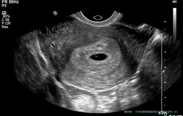 兰州试管双胞胎排名top5医院发布！2025年兰州试管双胞胎医院前五强详细对比：、费用、技术优势、医生团队及双胎妊娠注意事项全指南